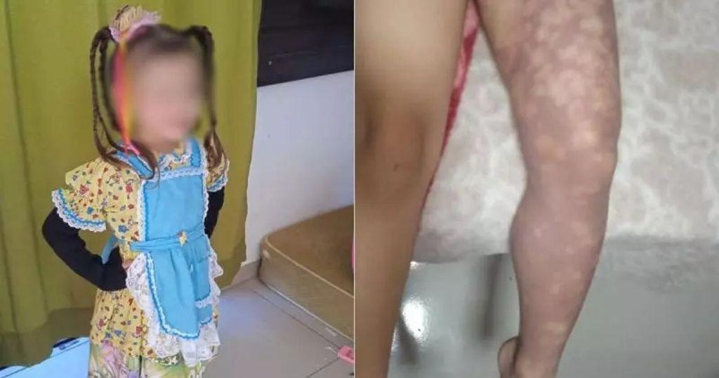 Menina de 4 anos tem perna amputada em SC após suspeita de erro na aplicação de injeção