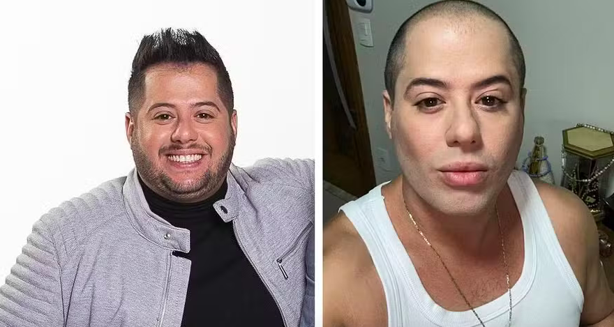 Sertanejo Hugo, da dupla com Tiago, surge bem diferente após harmonização e lipo.